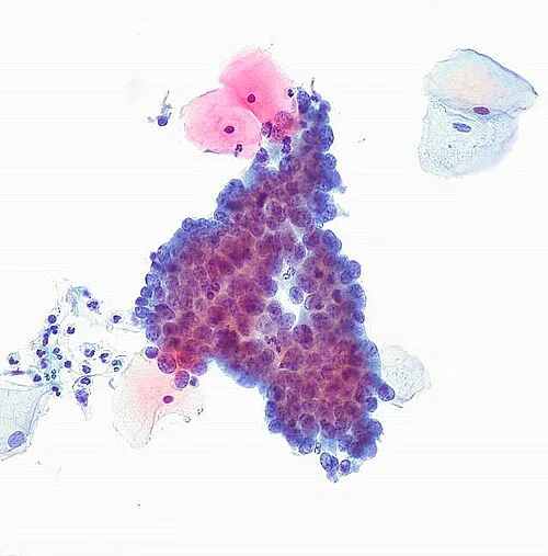 Cervical AIS, ThinPrep